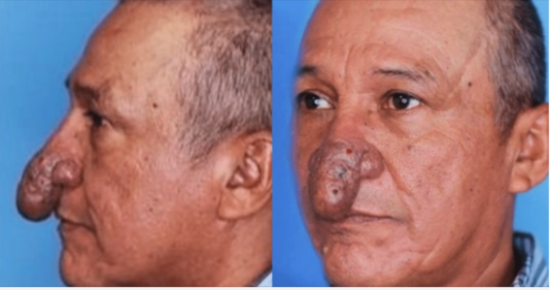 You Won’t Believe How Conrado’s Nose Transformed Overnight! See the Shocking Before and After!