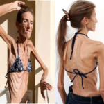 You Won’t Believe the Shocking Reason This Anorexic Teen Receives Fan Mail!