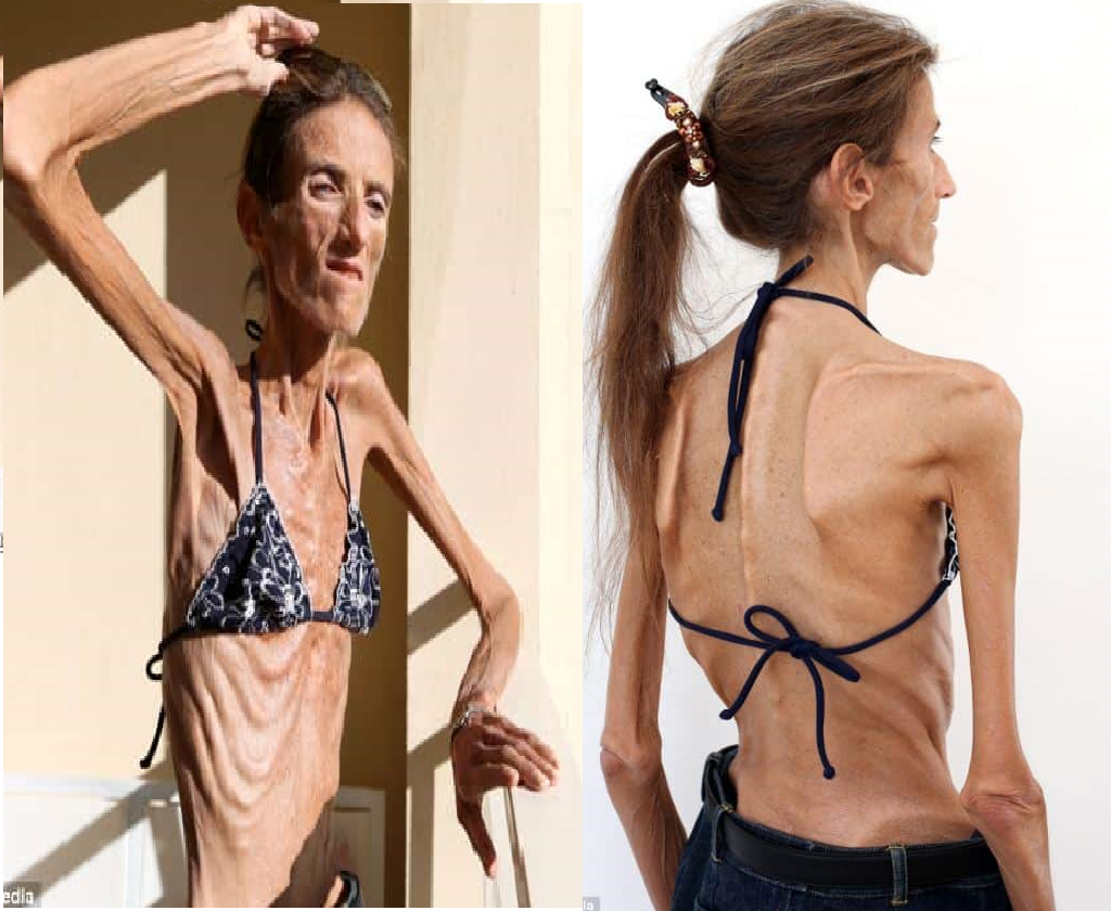 You Won’t Believe the Shocking Reason This Anorexic Teen Receives Fan Mail!