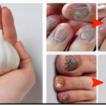 Erase Nail Fungus Naturally: Discover the Power of Garlic