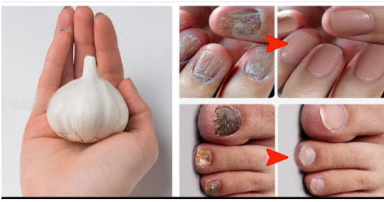 Erase Nail Fungus Naturally: Discover the Power of Garlic