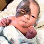 P3. Mom wants to show 13-month-old daughter with rare birthmark that she is beautiful