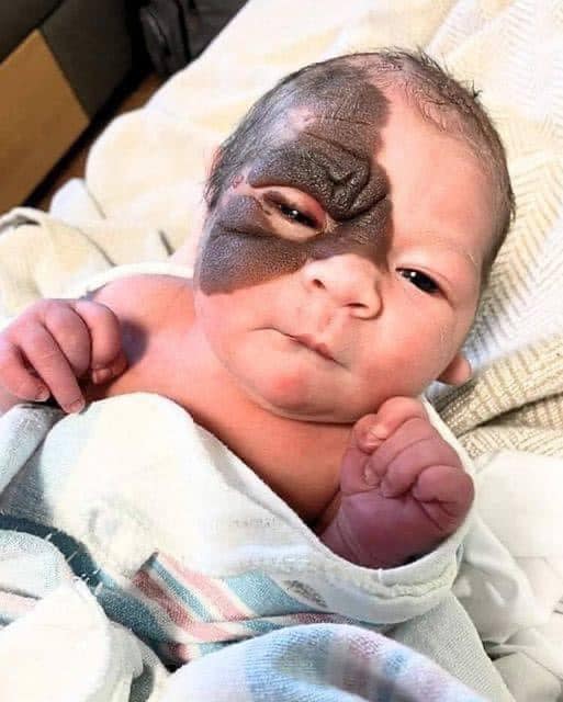 P3. Mom wants to show 13-month-old daughter with rare birthmark that she is beautiful