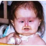 Unusual Syndrome at Birth: 22 Years Later